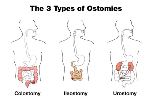 3 Types of Ostomies with Labels Blk_500x332
